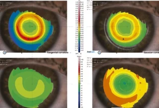 Cornea-550plus-Brochure-US-V1-July2025-6